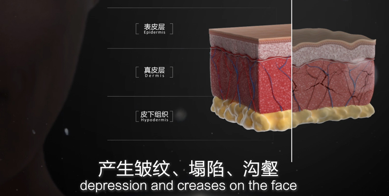 针美汇小针自体修复技术